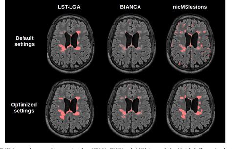 Figure 12 From Automatic Segmentation Of White Matter Hyperintensities