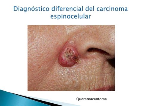 Carcinoma Basocelular Y Espinocelular Ppt