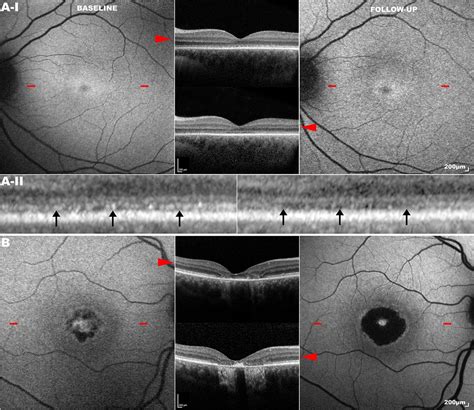 Progressive Cone And Cone Rod Dystrophies Clinical Features Molecular