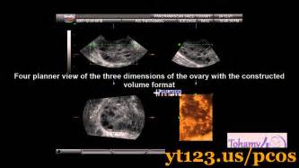 Removing Ovarian Cysts Laparoscopy Youtube