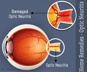 Home Remedies for Optic Neuritis