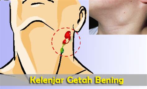 Apa Itu Kelenjar Getah Bening Penyebab Dan Gejalanya