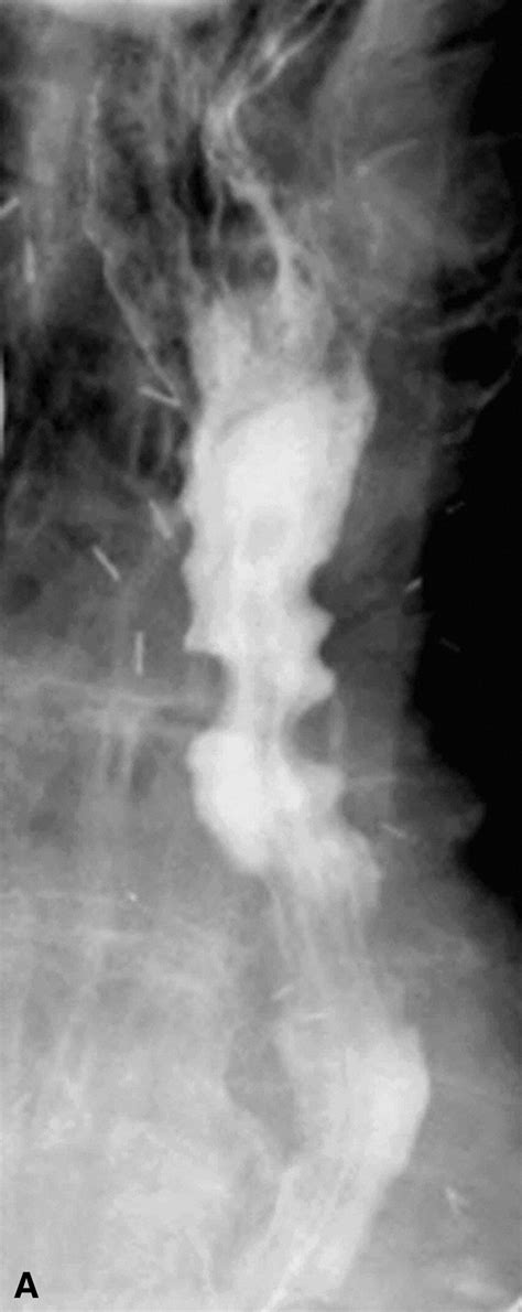 An unusual presentation of eosinophilic esophagitis - Gastrointestinal ...