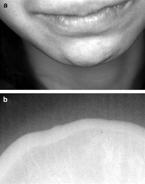 Figure From A Patient With Bizarre Parosteal Osteochondromatous