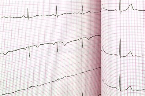 EKG test stock image. Image of beat, draw, analyse, graph - 64337283