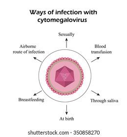 Cytomegalovirus Diseases Caused By Cytomegalovirus Infographics