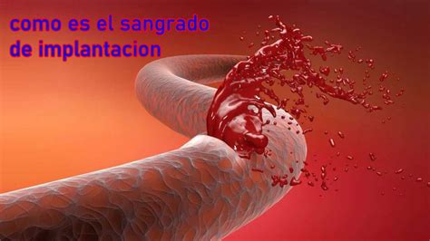 Como Es El Sangrado De Implantacion Una Gu A Completa