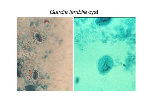 Giardiasis Giardia Lamblia Giardia Intestinalis презентация онлайн