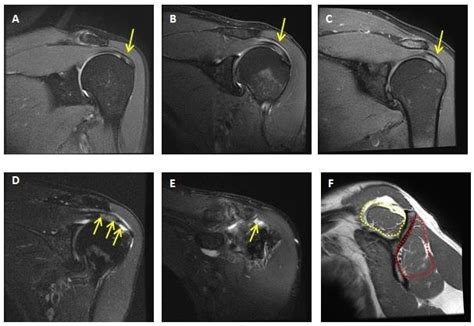 Examples Of Shoulder Mr Images Illustrating Tendinopathy Grading