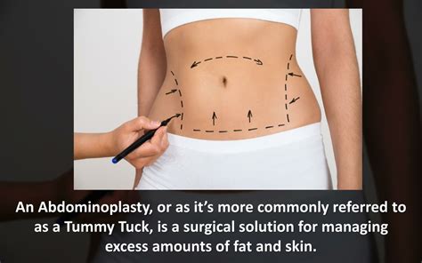 PPT Tummy Tuck Abdominoplasty Look As Great As You Feel