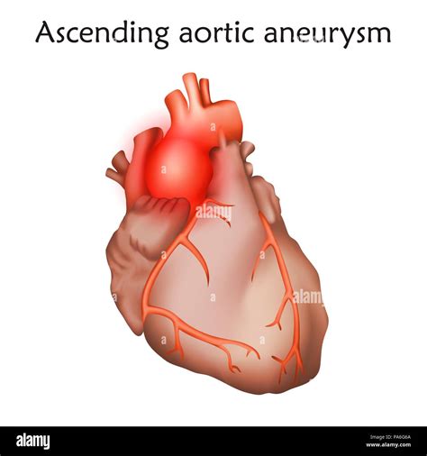 An Vrisme De L Aorte Ascendante De L Illustration L Largissement D