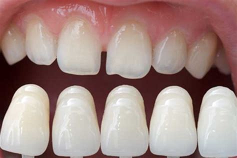 Full Crown Veneers Beenas Beauty Clinic