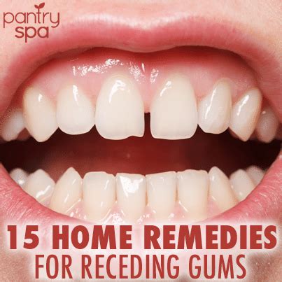 15 Home Remedies for Receding Gums (Natural DIY At Home Tips!)