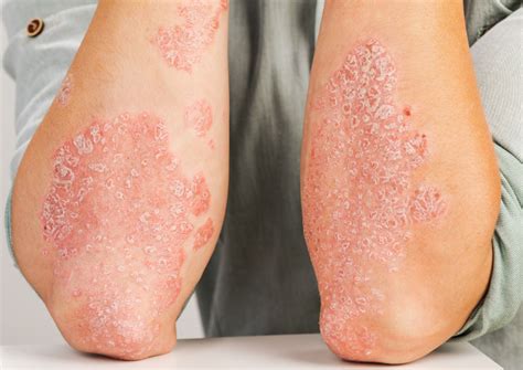 Leading Psoriasis Dermatologist Trillium Clinic