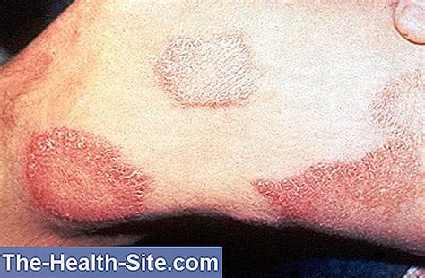 Alfuzosin: Effekter, Indikationer, Biverkningar 💊 Scientific-Praktisk ...