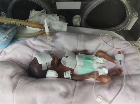 Extreme Premature Baby Discharged In Good Health SHINE News