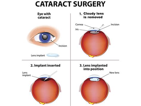 Best Cataract Surgery Hospital in Kerala, Cataract Surgery Cost in Kochi