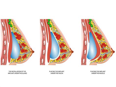 The Pros And Cons Of Breast Augmentation With Fat Transfer