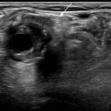 Ultrasound image of left popliteal artery aneurysm, causing ...