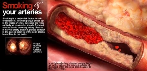 Smokers Arteries