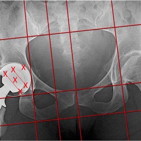 Supine Anteroposterior Pelvic Radiograph With Ein Bild Rontgen Analyse