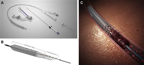 Single Session Thrombolysis Free Treatment Of Deep Vein Thrombosis With