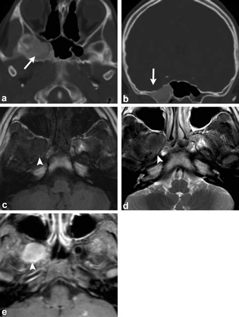 Radiological Review Of Skull Lesions Abstract Europe PMC