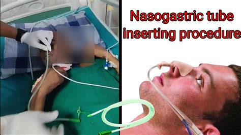 Nasogastric Tube Insertion Procedureryls Tube Insertion Procedure