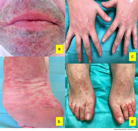 Onychomadesis Secondary To Hand Foot And Mouth Disease