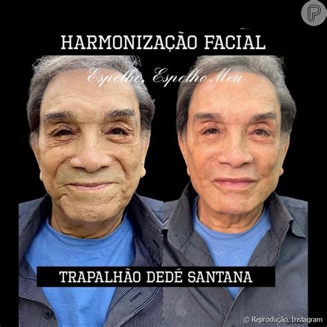 Dedé Santana antes e depois da harmonização facial Purepeople