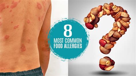 What Are The Most Common Food Allergies Symptoms Treatment