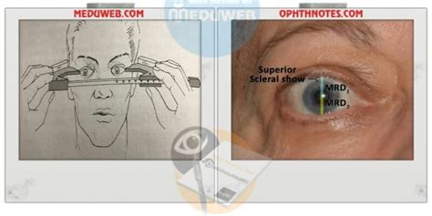 Laboratory diagnosis of Thyroid Eye Disease TED - Meduweb