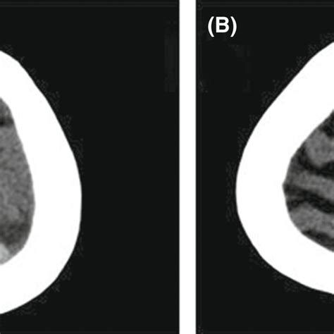 (A) Spiral brain computed tomography (CT) showed evidence of acute and... | Download Scientific ...