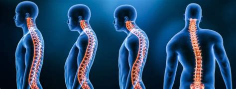 Kyphosis: Causes, Symptoms & Treatment | SoCal Scoliosis Care