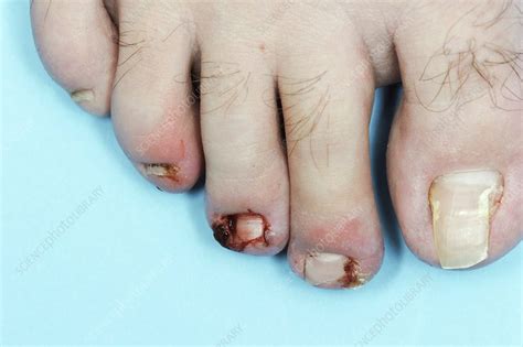 Infected Toe