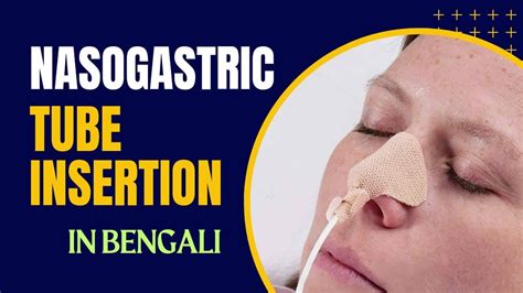 Nasogastric Tube Insertion In Bengaliryles Tube Insertion Full