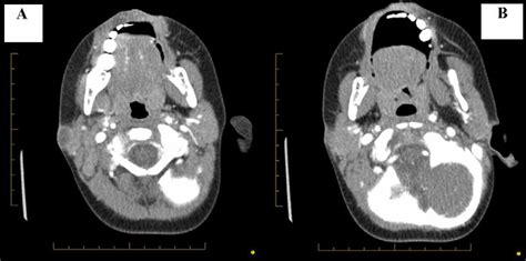 Neck Ct At Presentation A Nodal Enlargement With Central Necrosis