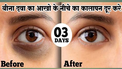 Dark Circles Kaise Hataye Remove Dark Circles Aankho Ke Niche Ka