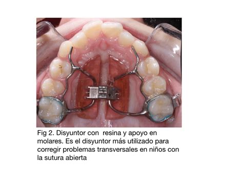 Expansión del maxilar del adulto con microtronillos o MARPE