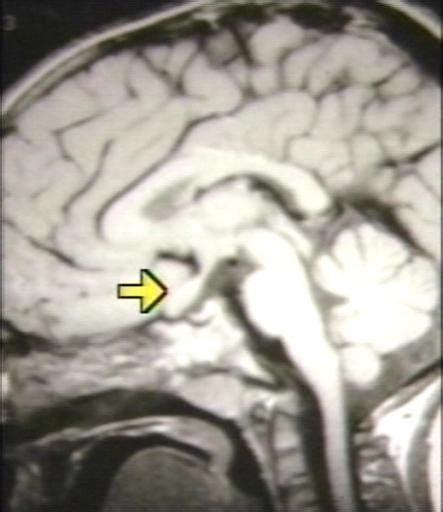 Glioma MRI - wikidoc