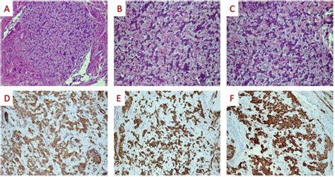 On Medium Power Examination The Tumor Is Nodular And Well