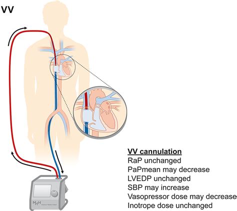 Triple Cannulation Ecmo Intechopen