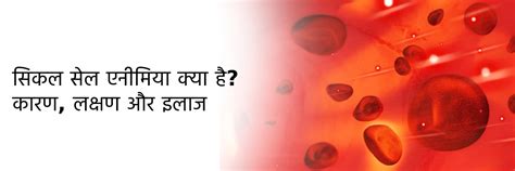 सिकल सेल एनीमिया क्या है कारण लक्षण और इलाज Sickle Cell Anemia In Hindi