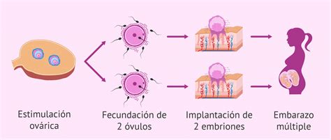 Los Embarazos Múltiples En Reproducción Asistida Ventajas Y Desventajas