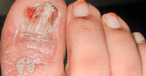 Nail Lichen Planus Image