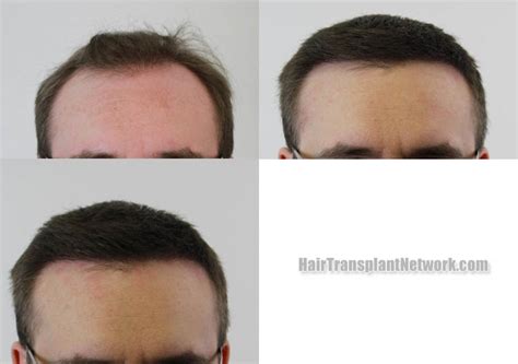 Dr H Rahal Hair Transplant Procedure Before And After Result Photos