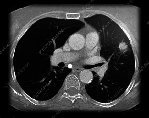 Lung mass, CT scan - Stock Image - C058/4505 - Science Photo Library