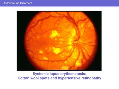 PPT Ocular Manifestations Of Systemic Disease PowerPoint Presentation