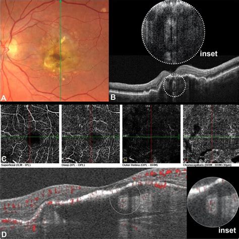 Multimodal Imaging Of A Sub Retinal Pigment Epithelium Rpe Tubule