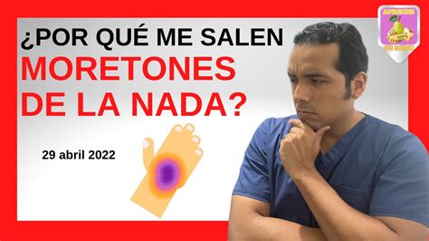 Te Interesa Conoce Las Causas Por Las Que Te Salen Moretones